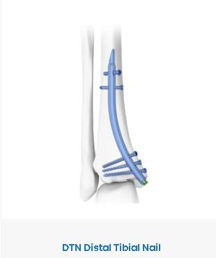 Дистальний великогомілковий стрижень правий (Double Medical Technology Inc.)